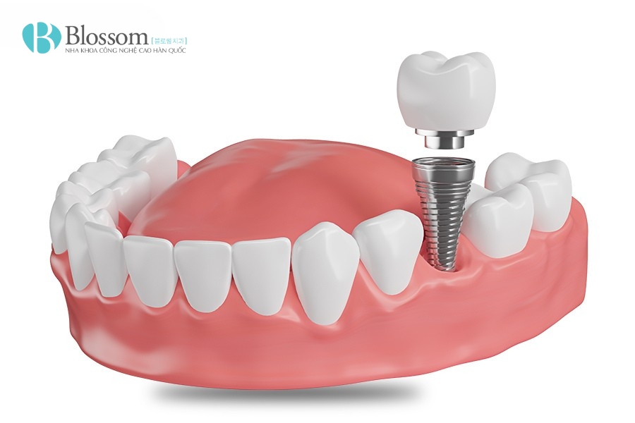 Khi nào cần trồng răng hàm bị sâu? Phương pháp nào tốt, giá bao nhiêu? 5 trong rang ham bi sau 5