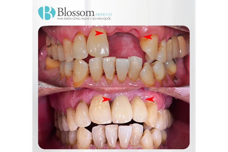 Khi nào cần trồng răng hàm bị sâu? Phương pháp nào tốt, giá bao nhiêu? 6 trong rang ham bi sau 7