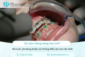 Có nên niềng răng cho trẻ? Độ tuổi, phương pháp và những điều ba mẹ cần biết