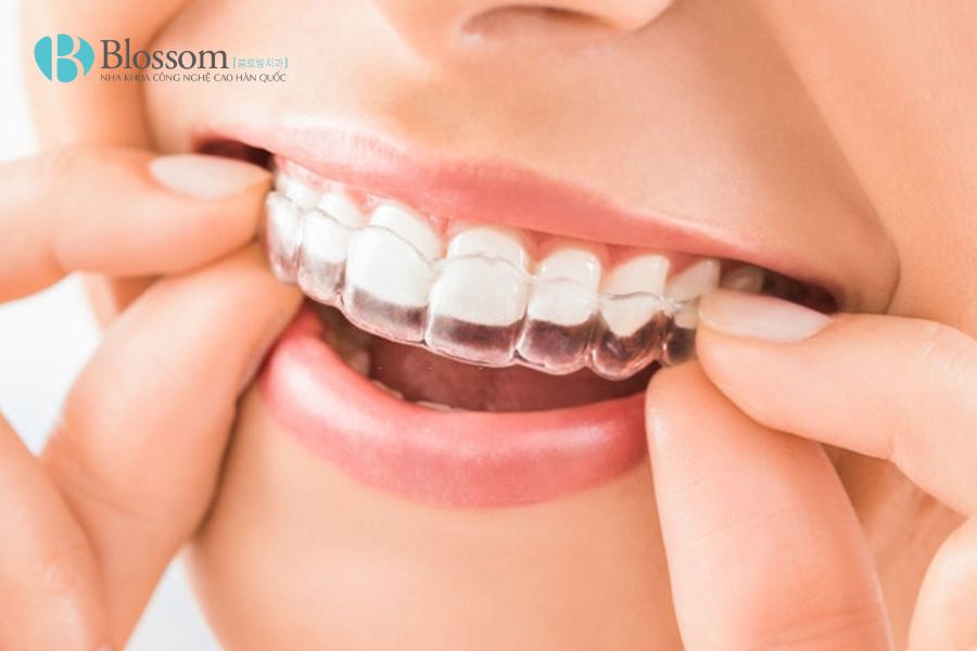 bac si kim dong hyun nieng invisalign 1