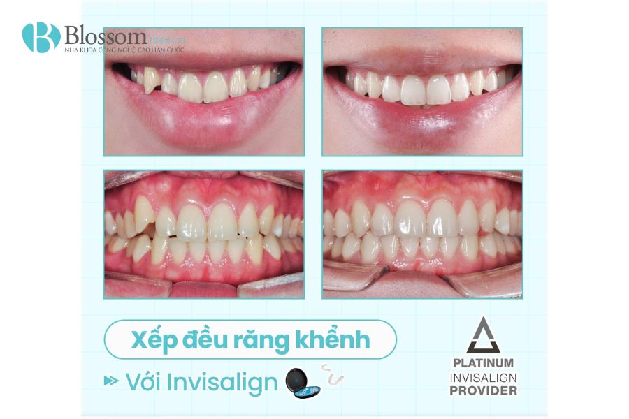 bac si kim dong hyun nieng invisalign 6