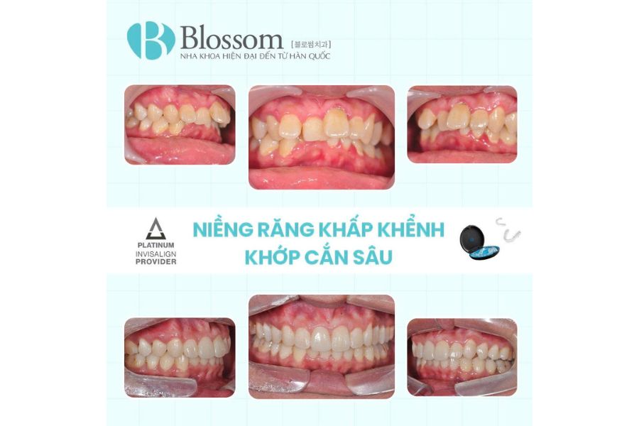 bac si kim dong hyun nieng invisalign 7