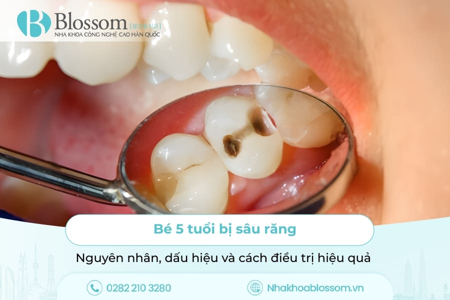 Bé 5 tuổi bị sâu răng: Nguyên nhân, dấu hiệu và cách điều trị hiệu quả