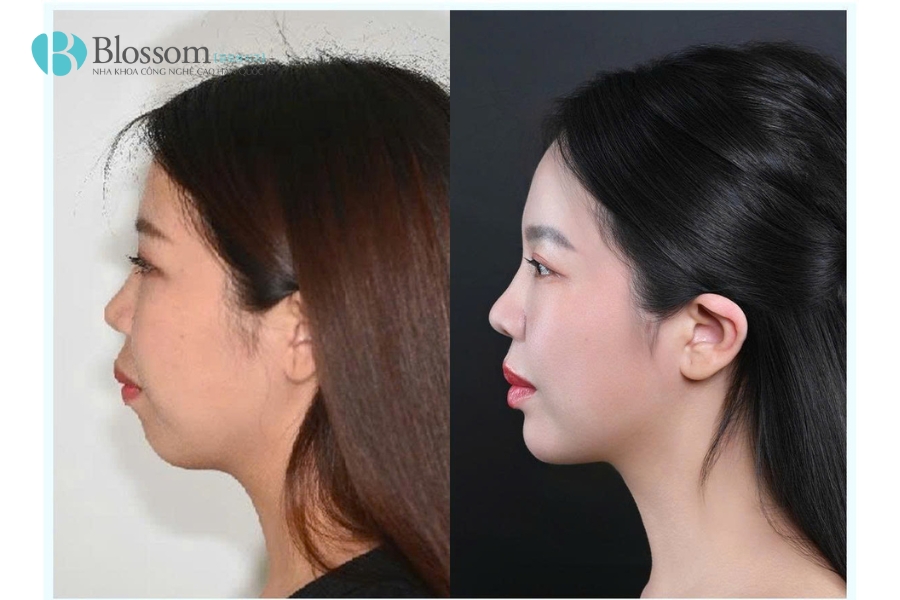 Nha khoa Blossom tiếp tục khẳng định vị thế khi đạt danh hiệu Invisalign Platinum Provider 2024 tại hội nghị thượng đỉnh Invisalign APAC 2025 10 blossom dat danh hieu invisalign platinum provider 2024 10
