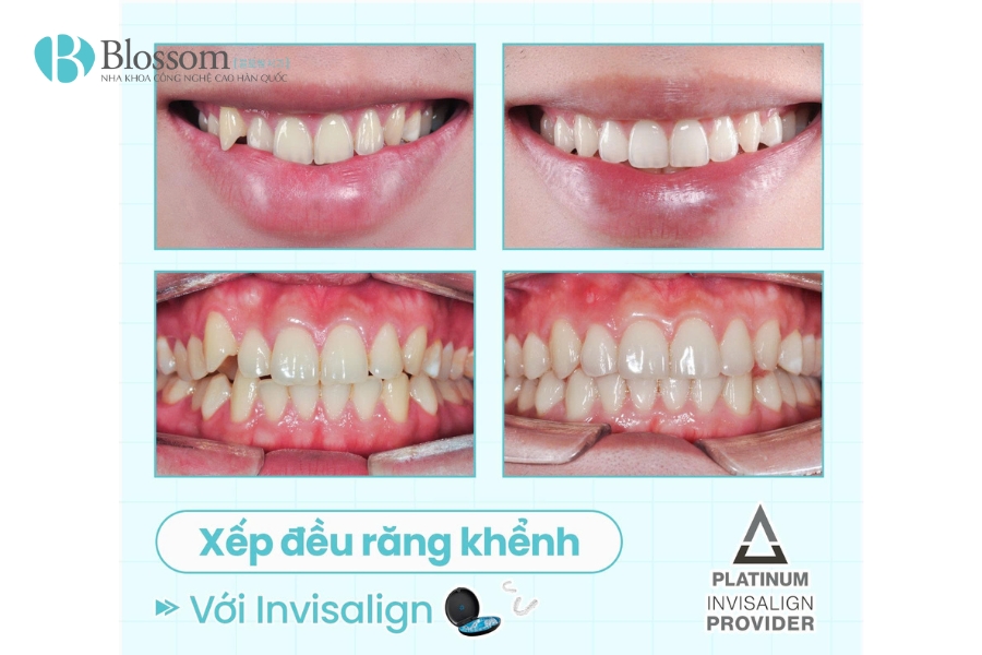 Nha khoa Blossom tiếp tục khẳng định vị thế khi đạt danh hiệu Invisalign Platinum Provider 2024 tại hội nghị thượng đỉnh Invisalign APAC 2025 6 blossom dat danh hieu invisalign platinum provider 2024 6