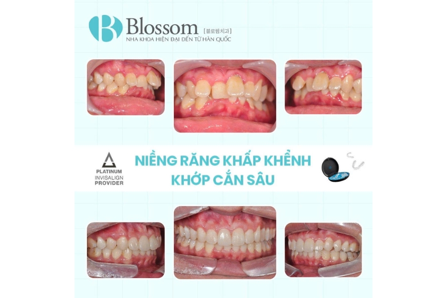 Nha khoa Blossom tiếp tục khẳng định vị thế khi đạt danh hiệu Invisalign Platinum Provider 2024 tại hội nghị thượng đỉnh Invisalign APAC 2025 8 blossom dat danh hieu invisalign platinum provider 2024 8