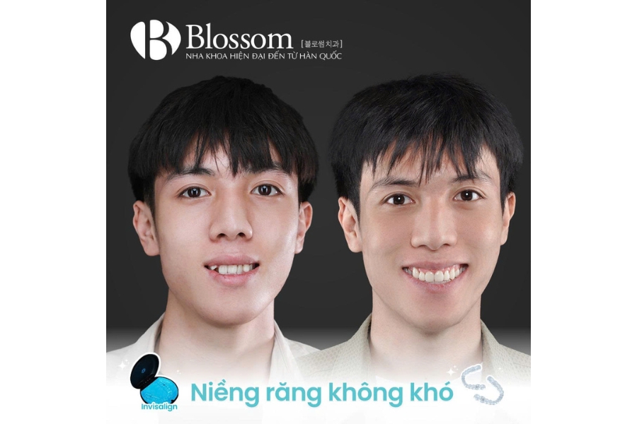 Nha khoa Blossom tiếp tục khẳng định vị thế khi đạt danh hiệu Invisalign Platinum Provider 2024 tại hội nghị thượng đỉnh Invisalign APAC 2025 9 blossom dat danh hieu invisalign platinum provider 2024 9
