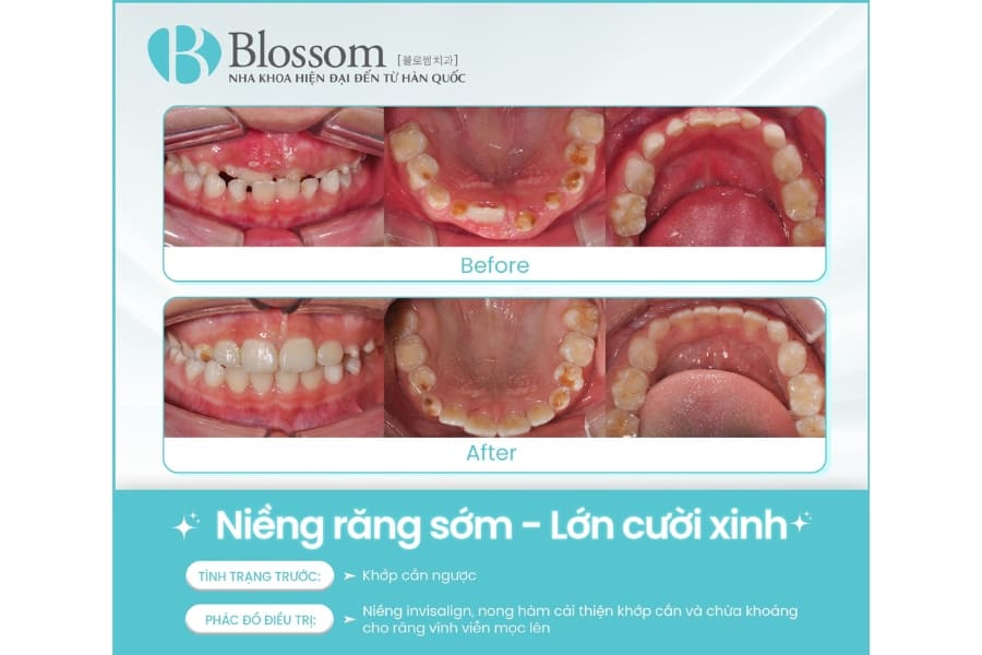 gia nieng rang cho tre 2 2