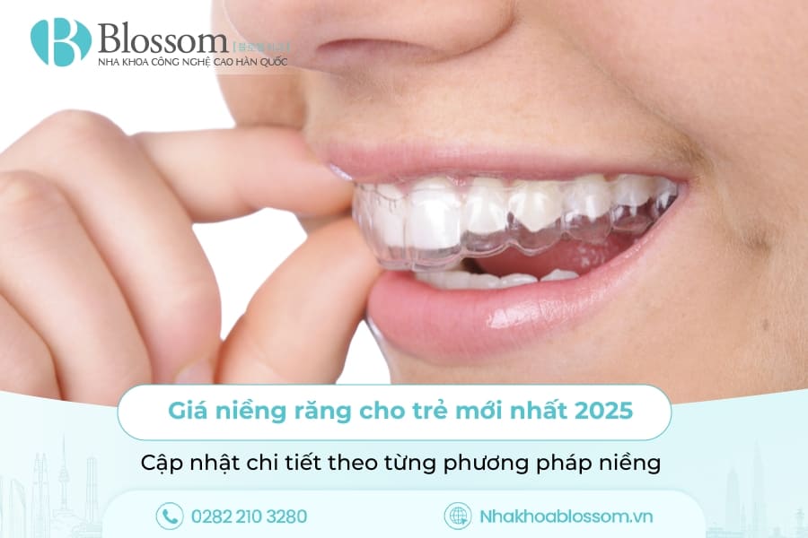Giá niềng răng cho trẻ mới nhất 2025 – Cập nhật chi tiết theo từng phương pháp niềng