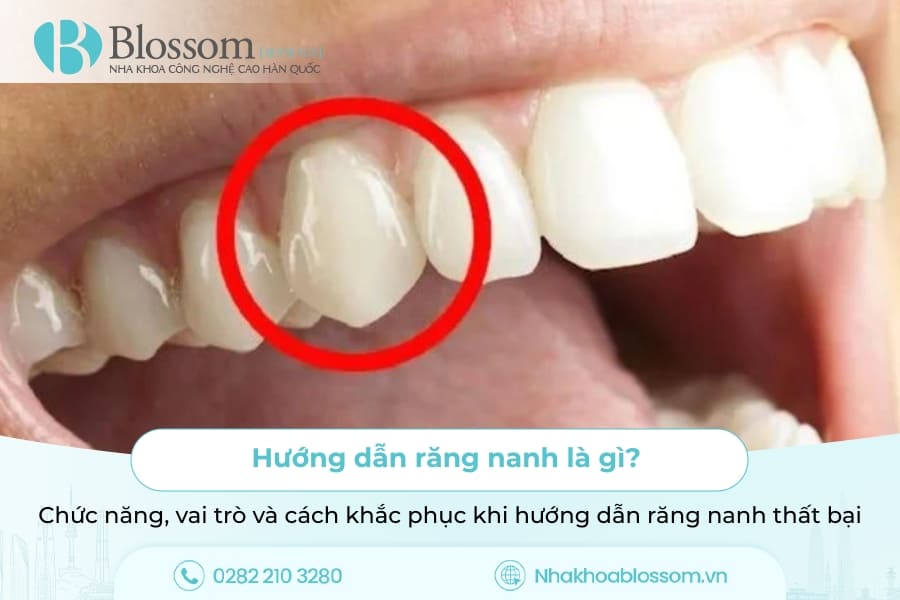 Hướng dẫn răng nanh là gì? Chức năng, vai trò và cách khắc phục khi hướng dẫn răng nanh thất bại
