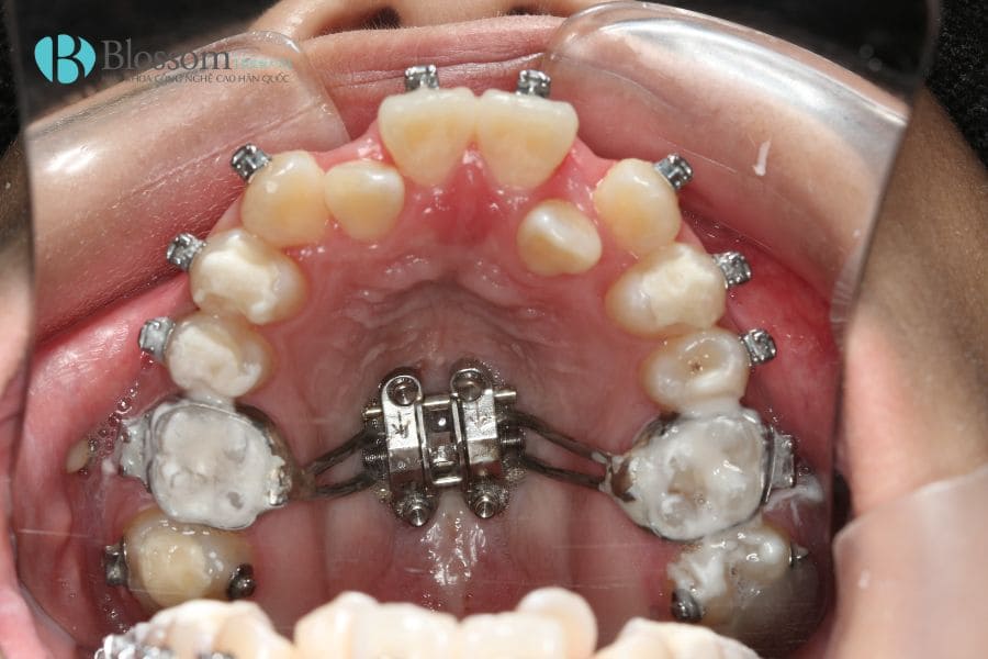 Nong hàm cho trẻ em: Lợi ích, phương pháp và những lưu ý quan trọng mà ba mẹ nên chú ý 1 nong ham cho tre em 1