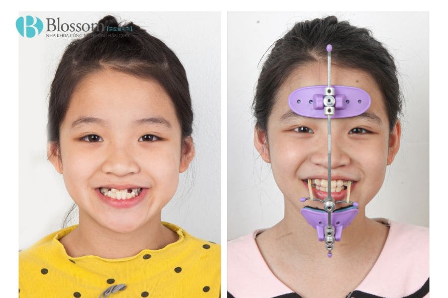Nong hàm cho trẻ em: Lợi ích, phương pháp và những lưu ý quan trọng mà ba mẹ nên chú ý 2 nong ham cho tre em 2