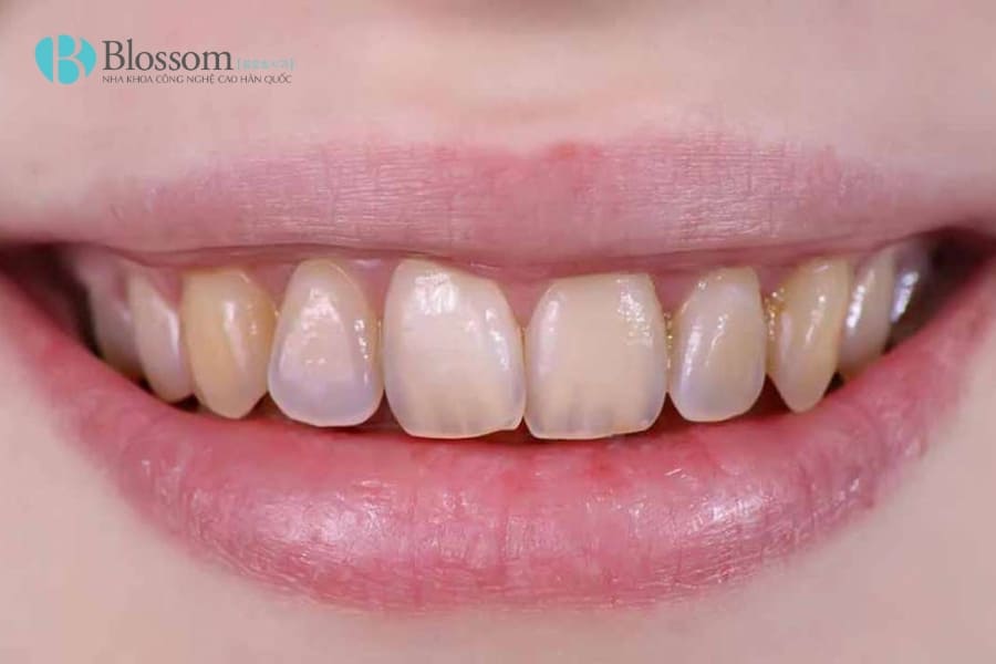 Phục hồi men răng - Giải pháp tự nhiên giúp răng chắc khỏe, hết ê buốt 2 phuc hoi men rang 2 1