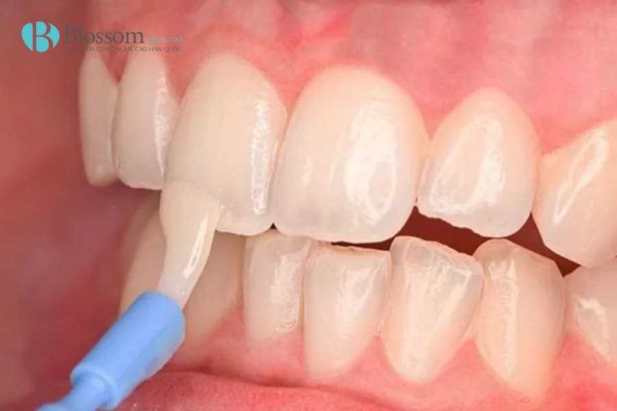 Phục hồi men răng - Giải pháp tự nhiên giúp răng chắc khỏe, hết ê buốt 3 phuc hoi men rang 3 1