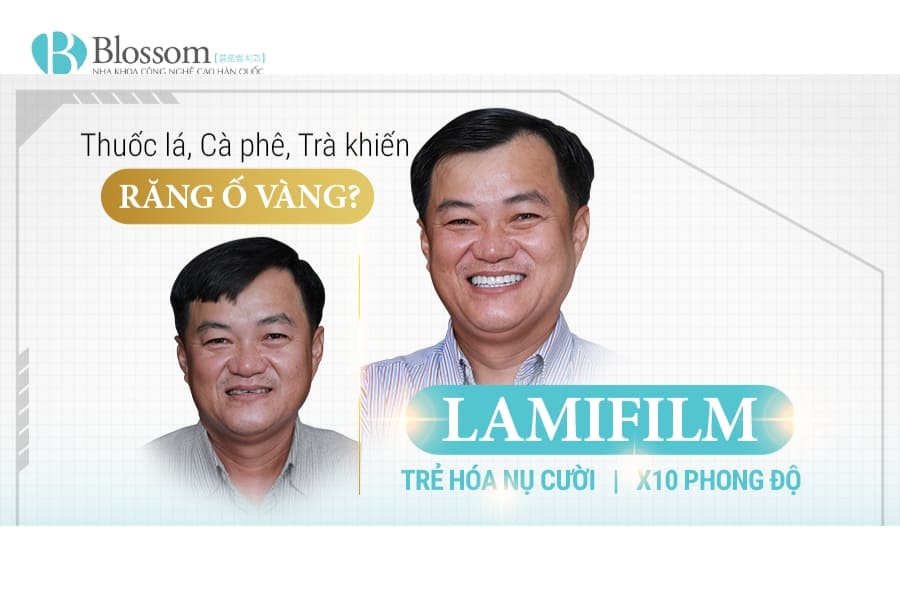 Phục hồi men răng - Giải pháp tự nhiên giúp răng chắc khỏe, hết ê buốt 6 phuc hoi men rang 6 1