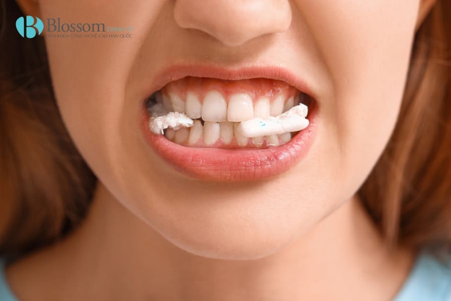 Phục hồi men răng - Giải pháp tự nhiên giúp răng chắc khỏe, hết ê buốt 8 phuc hoi men rang 8 1