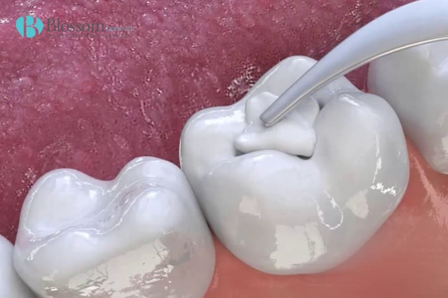 Răng bị mòn mặt nhai: Nguyên nhân, tác hại và giải pháp với dán sứ Lamifilm 4 rang bi mon mat nhai 4