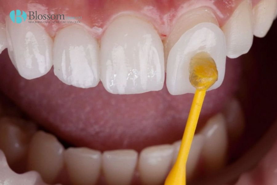 tac hai cua dan su veneer 4