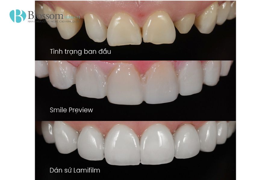 tac hai cua dan su veneer 5