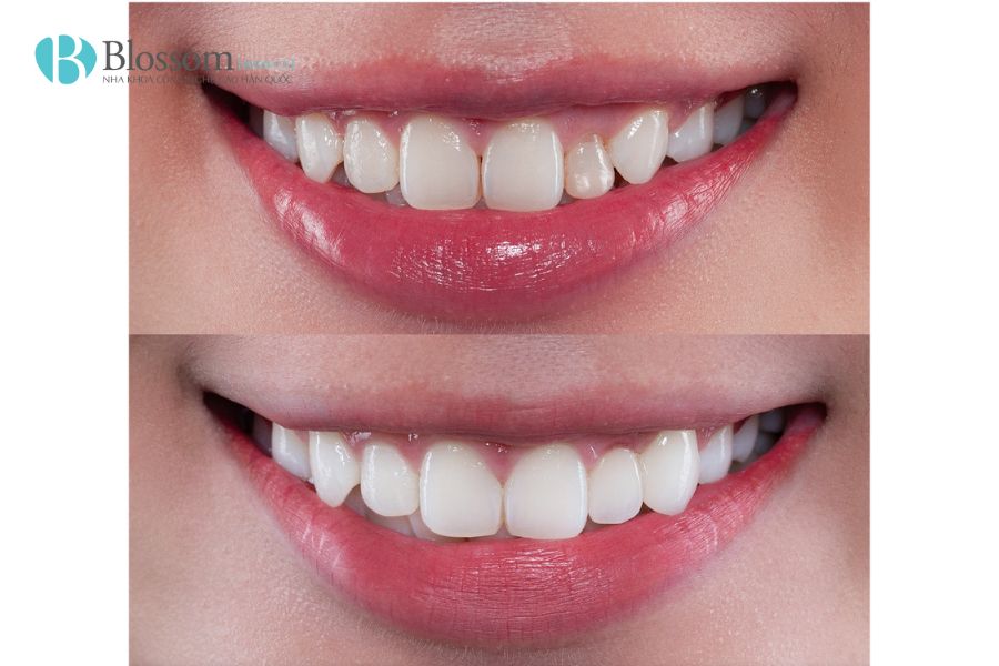 tac hai cua dan su veneer 6