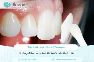 Tác hại của dán sứ Veneer – Những điều bạn cần biết trước khi thực hiện