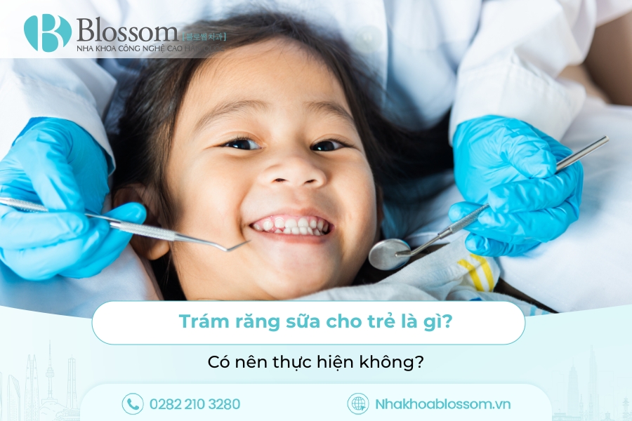 Trám răng sữa cho trẻ là gì? Có nên thực hiện không?