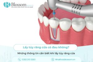 Lấy tủy răng cửa có đau không? Những thông tin cần biết khi lấy tủy răng cửa