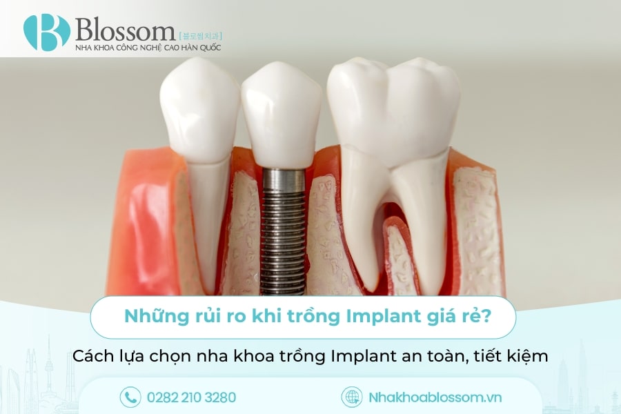 Những rủi ro khi trồng Implant giá rẻ? Cách lựa chọn nha khoa trồng Implant an toàn, tiết kiệm