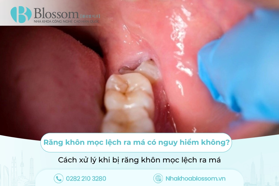 Răng khôn mọc lệch ra má có nguy hiểm không? Cách xử lý khi bị răng khôn mọc lệch ra má