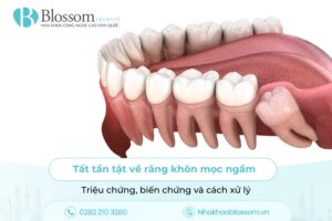 Tất tần tật về răng khôn mọc ngầm: Triệu chứng, biến chứng và cách xử lý