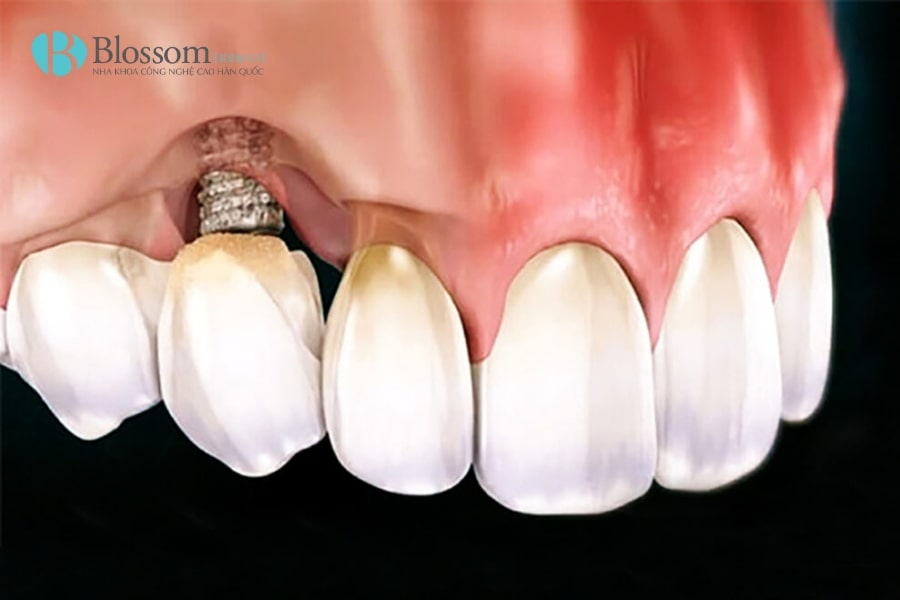 Những rủi ro khi trồng Implant giá rẻ? Cách lựa chọn nha khoa trồng Implant an toàn, tiết kiệm 1 implant gia re 1 min
