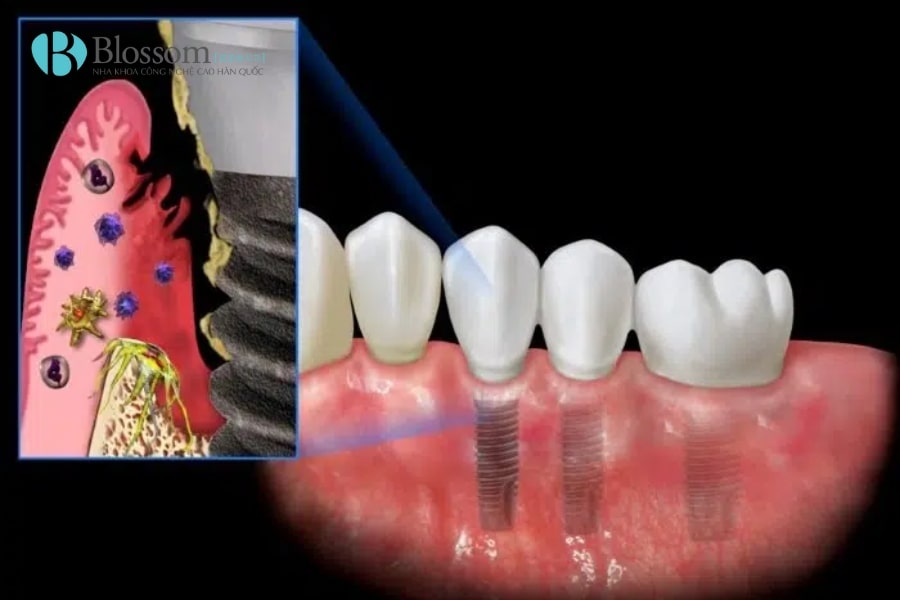 Những rủi ro khi trồng Implant giá rẻ? Cách lựa chọn nha khoa trồng Implant an toàn, tiết kiệm 2 implant gia re 2 min