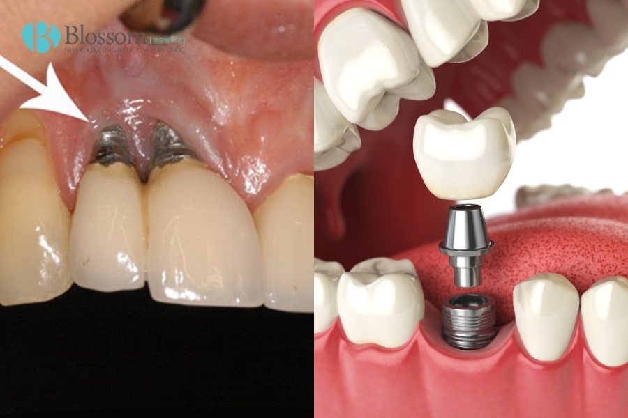Những rủi ro khi trồng Implant giá rẻ? Cách lựa chọn nha khoa trồng Implant an toàn, tiết kiệm 3 implant gia re 3 min