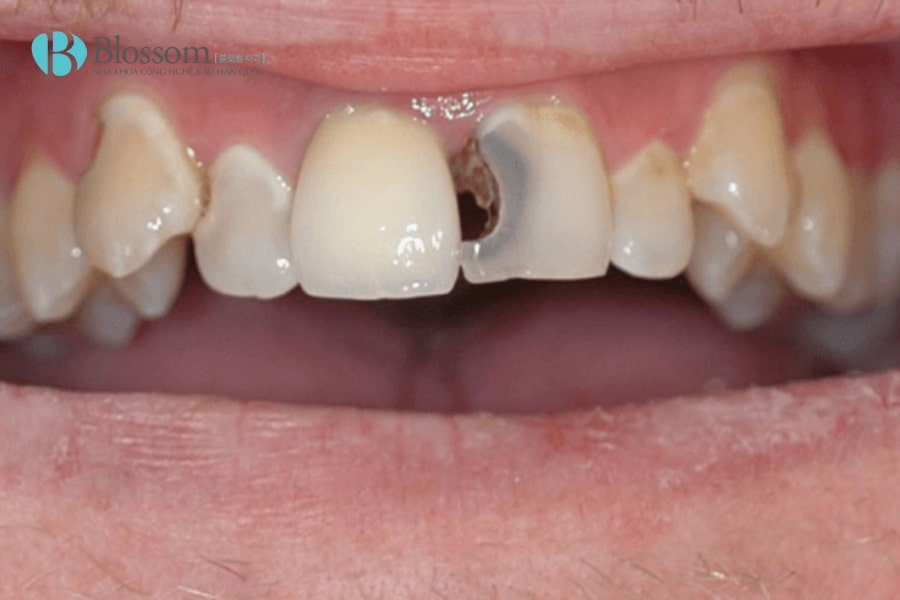Lấy tủy răng cửa có đau không? Những thông tin cần biết khi lấy tủy răng cửa 2 lay tuy rang cua 2 min