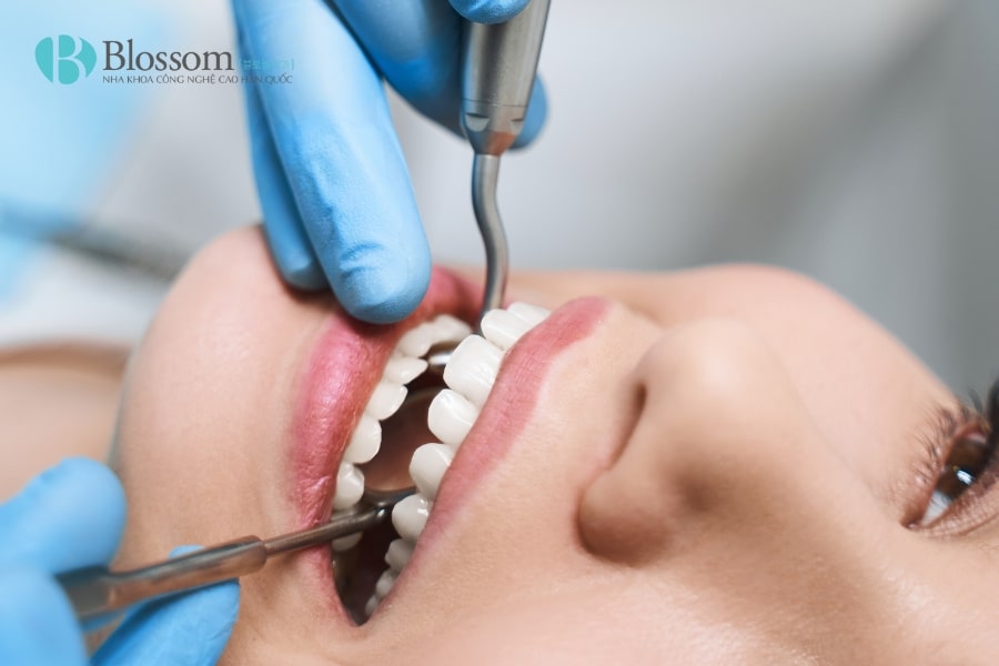Lấy tủy răng cửa có đau không? Những thông tin cần biết khi lấy tủy răng cửa 3 lay tuy rang cua 3 min