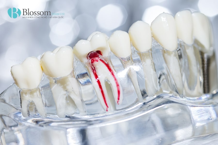 Lấy tủy răng cửa có đau không? Những thông tin cần biết khi lấy tủy răng cửa 4 lay tuy rang cua 4 min
