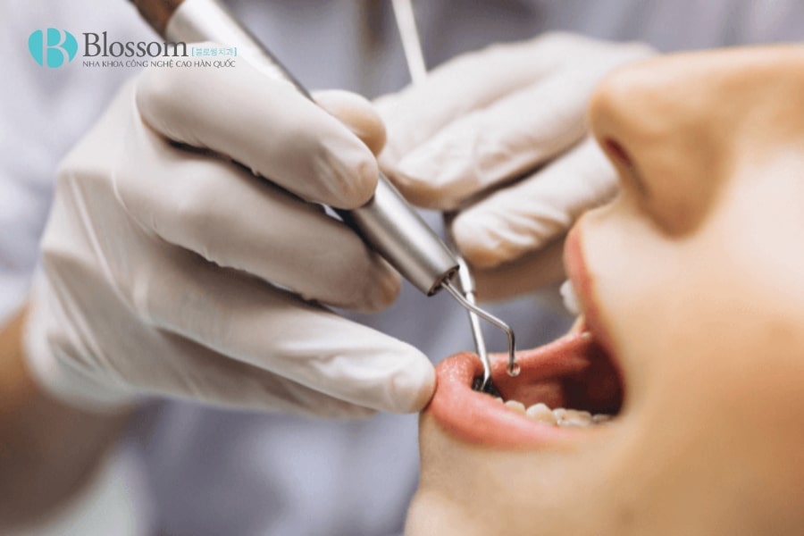 Lấy tủy răng cửa có đau không? Những thông tin cần biết khi lấy tủy răng cửa 5 lay tuy rang cua 5 min