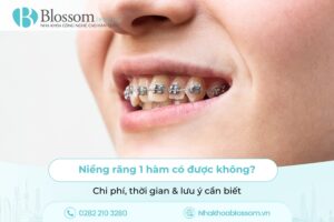 Niềng răng 1 hàm có được không? Chi phí, thời gian & lưu ý cần biết