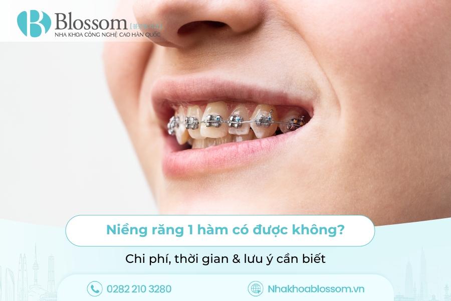 Niềng răng 1 hàm có được không? Chi phí, thời gian & lưu ý cần biết