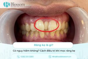 Răng kẹ là gì? Có nguy hiểm không? Cách điều trị khi mọc răng kẹ