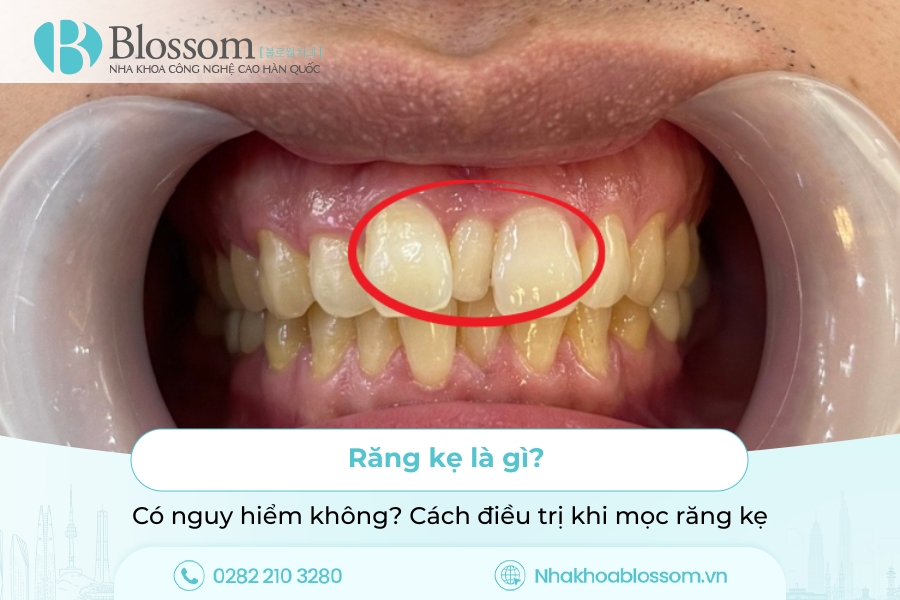 Răng kẹ là gì? Có nguy hiểm không? Cách điều trị khi mọc răng kẹ