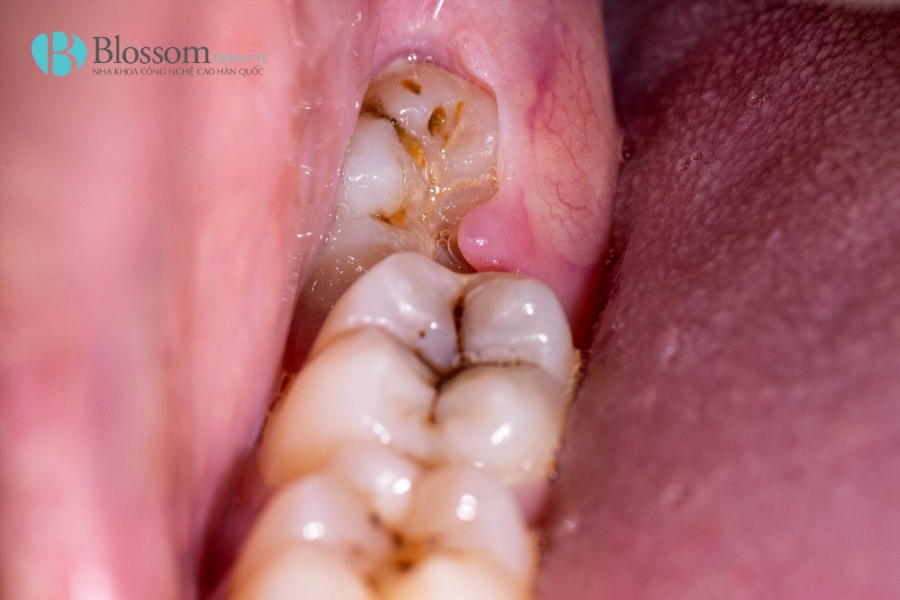 Răng khôn mọc lệch ra má có nguy hiểm không? Cách xử lý khi bị răng khôn mọc lệch ra má 2 rang khon moc lech ra ma 2
