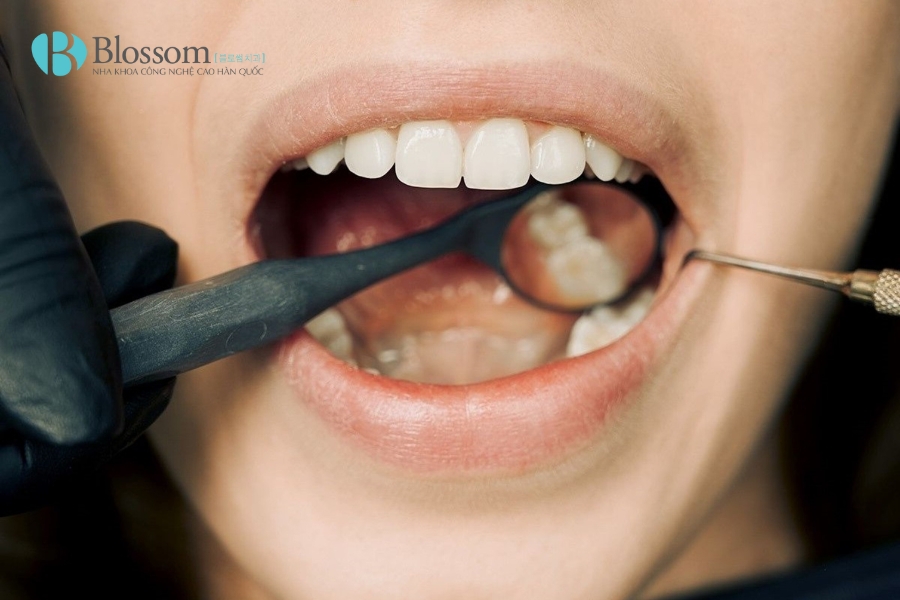 Răng khôn mọc lệch ra má có nguy hiểm không? Cách xử lý khi bị răng khôn mọc lệch ra má 5 rang khon moc lech ra ma 5