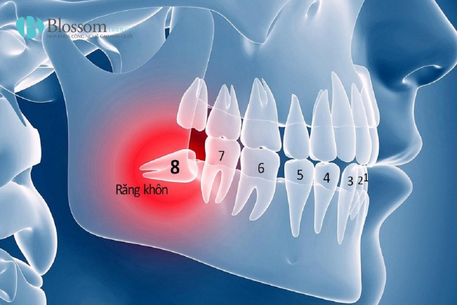Tất tần tật về răng khôn mọc ngầm: Triệu chứng, biến chứng và cách xử lý 1 rang khon moc ngam 1