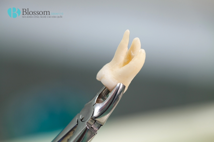 Tất tần tật về răng khôn mọc ngầm: Triệu chứng, biến chứng và cách xử lý 5 rang khon moc ngam 5
