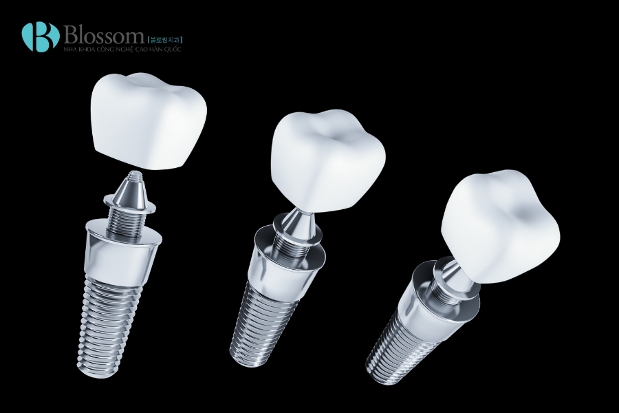 trong rang implant co di may bay duoc khong 1