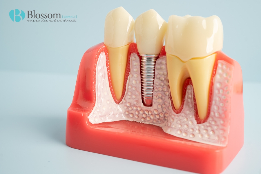 trong rang implant co di may bay duoc khong 3