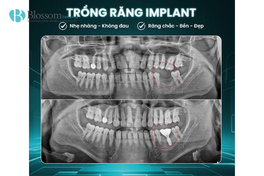 trong rang implant co di may bay duoc khong 5