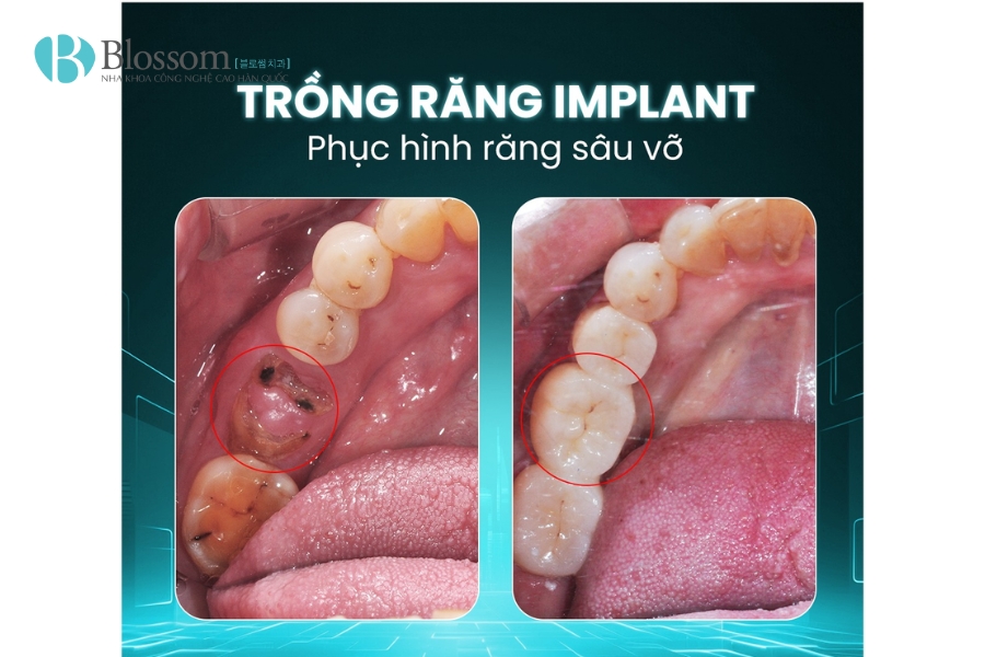 trong rang implant co di may bay duoc khong 6
