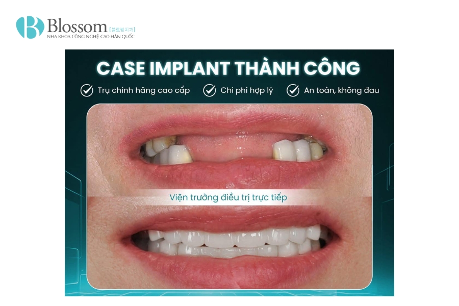 trong rang implant co di may bay duoc khong 8